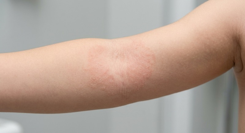 Child's arm showing mild eczema patches